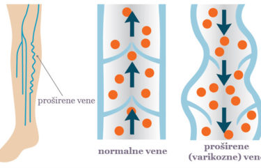 Varicose veins and spider veins